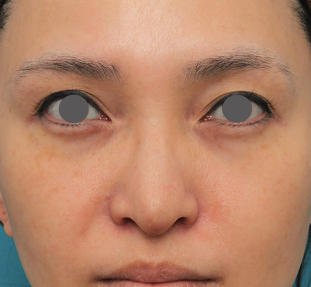 鼻翼縮小（小鼻縮小）,魔女鼻に対して垂れ鼻修正手術と小鼻縮小手術を同時に行った症例写真,6日後,mainpic_tarebana001c.jpg