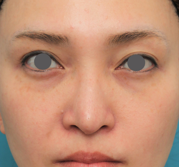 鼻翼縮小（小鼻縮小）,魔女鼻に対して垂れ鼻修正手術と小鼻縮小手術を同時に行った症例写真,6ヶ月後,mainpic_tarebana001e.jpg