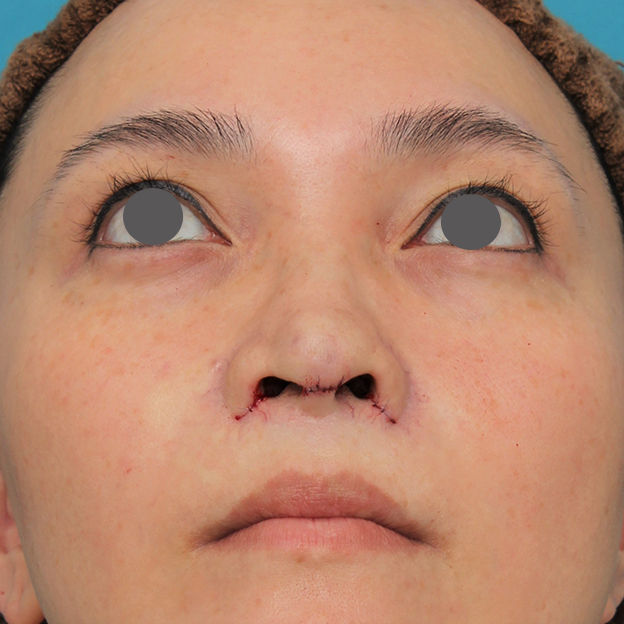 鼻翼縮小（小鼻縮小）,魔女鼻に対して垂れ鼻修正手術と小鼻縮小手術を同時に行った症例写真,手術直後,mainpic_tarebana001g.jpg