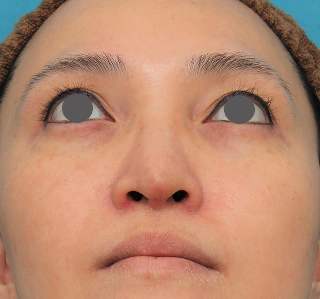 鼻翼縮小（小鼻縮小）,魔女鼻に対して垂れ鼻修正手術と小鼻縮小手術を同時に行った症例写真,6日後,mainpic_tarebana001h.jpg