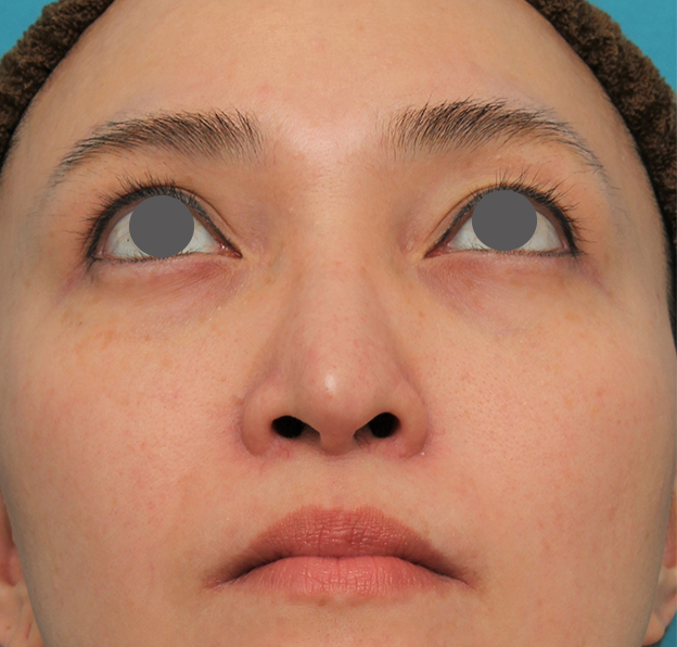 鼻翼縮小（小鼻縮小）,魔女鼻に対して垂れ鼻修正手術と小鼻縮小手術を同時に行った症例写真,6ヶ月後,mainpic_tarebana001j.jpg