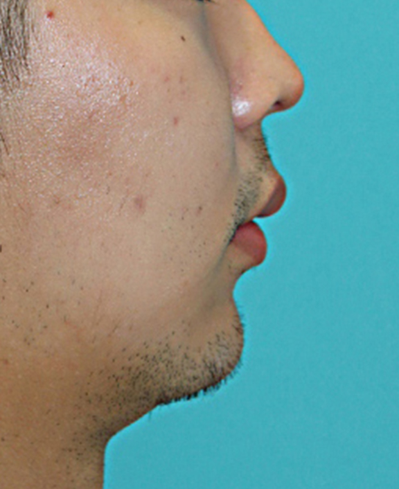 耳の軟骨を移植して、鼻先を自然に出した症例写真,After（8日後）,ba_jikai044_a01.jpg