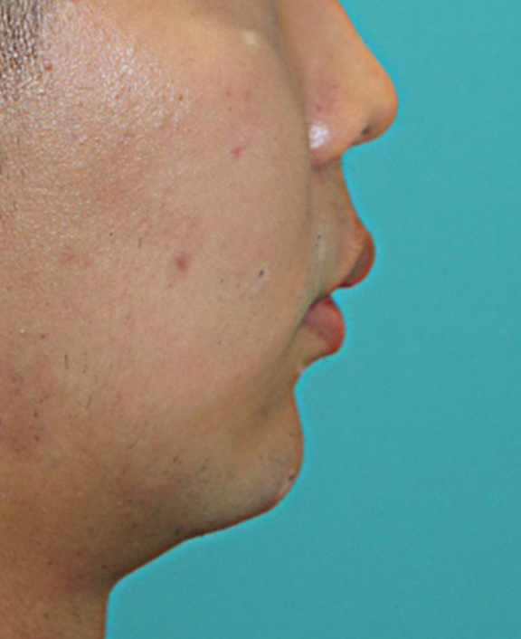 耳の軟骨を移植して、鼻先を自然に出した症例写真,Before,ba_jikai045_b01.jpg