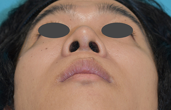 症例写真,鼻尖形成の症例写真,After（1ヶ月後）,ba_bisen028_b03.jpg