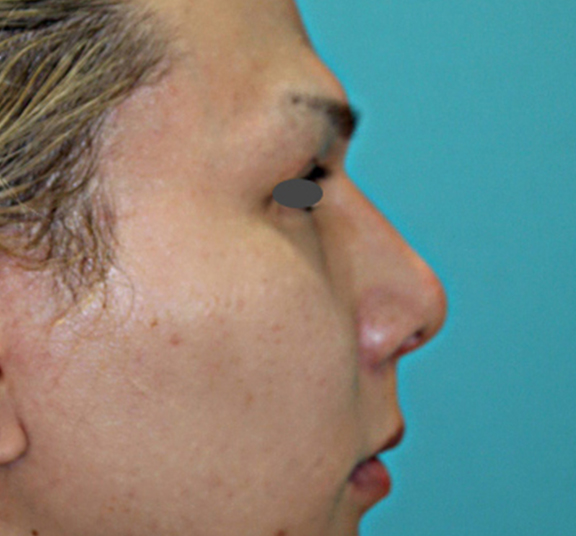 わし鼻・段鼻修正,ハンプ切除,ハンプ骨切り+隆鼻プロテーゼ+耳介軟骨移植の症例写真,After（1年後）,ba_hump013_b01.jpg