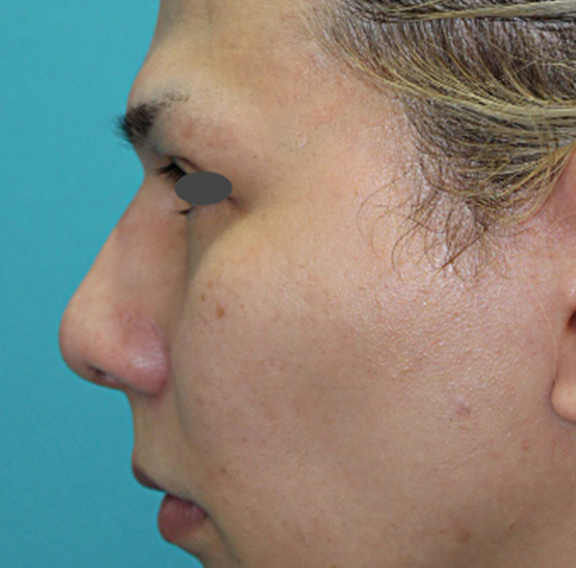 わし鼻・段鼻修正,ハンプ切除,ハンプ骨切り+隆鼻プロテーゼ+耳介軟骨移植の症例写真,After（1年後）,ba_hump013_b02.jpg