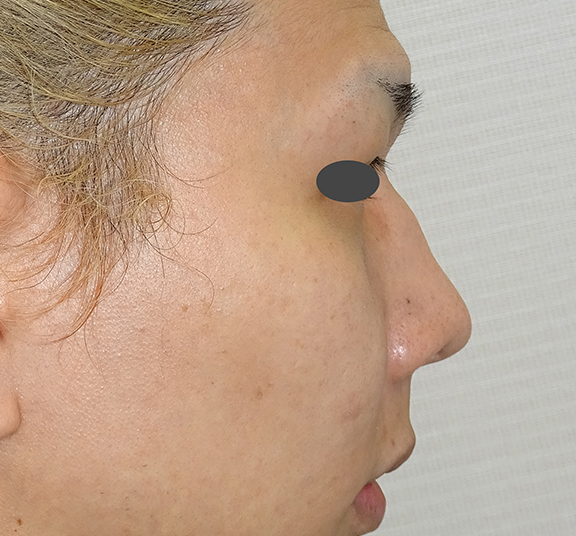 わし鼻・段鼻修正,ハンプ切除,ハンプ骨切り+隆鼻プロテーゼ+耳介軟骨移植の症例写真,Before,ba_hump013_b01.jpg