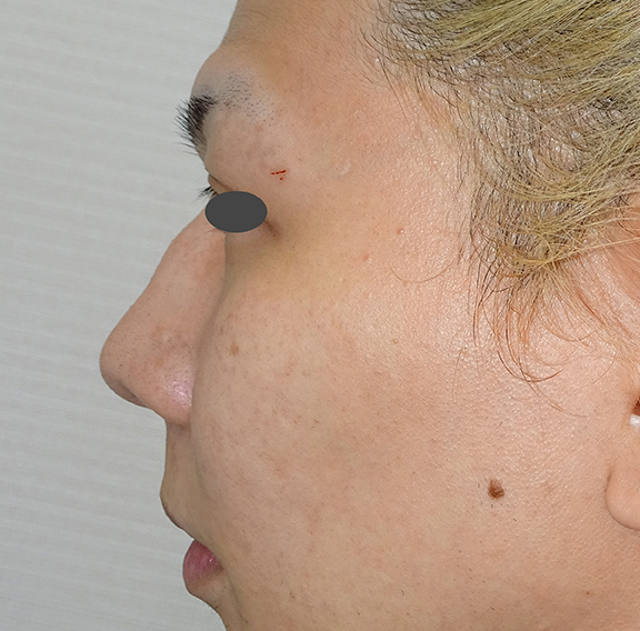 わし鼻・段鼻修正,ハンプ切除,ハンプ骨切り+隆鼻プロテーゼ+耳介軟骨移植の症例写真,Before,ba_hump013_b02.jpg