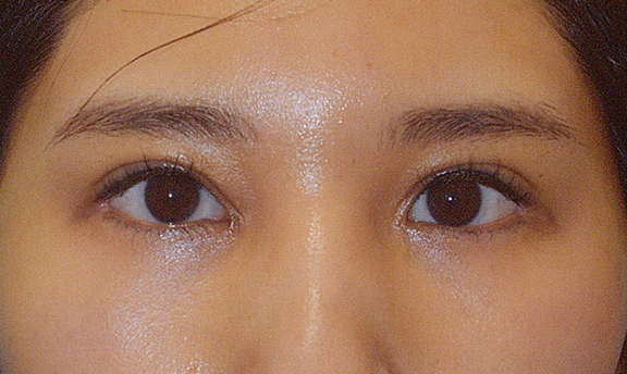 眼瞼下垂（がんけんかすい）,蒙古ひだ形成・目頭切開後の修正,他院で受けた手術の修正（二重まぶた・目もと）,眼瞼下垂症手術+蒙古襞形成の症例写真,After（2ヶ月後）,ba_ganken040_a01.jpg