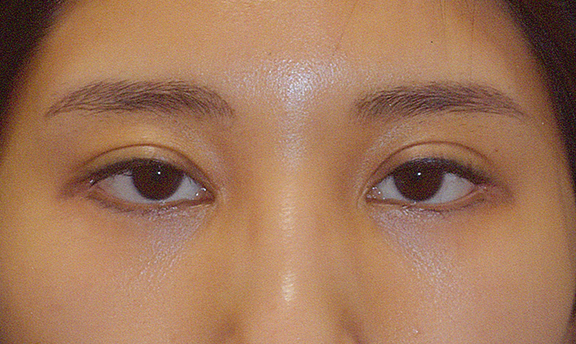 他院で受けた手術の修正（二重まぶた・目もと）,眼瞼下垂症手術+蒙古襞形成の症例写真,Before,ba_ganken040_b01.jpg