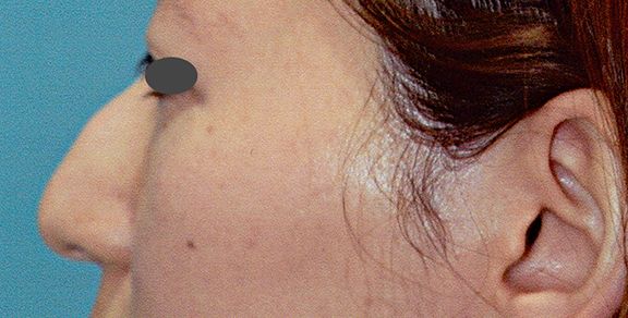 わし鼻・段鼻修正,ハンプ切除,ハンプ骨切り切除の症例写真,Before,ba_hump014_b01.jpg