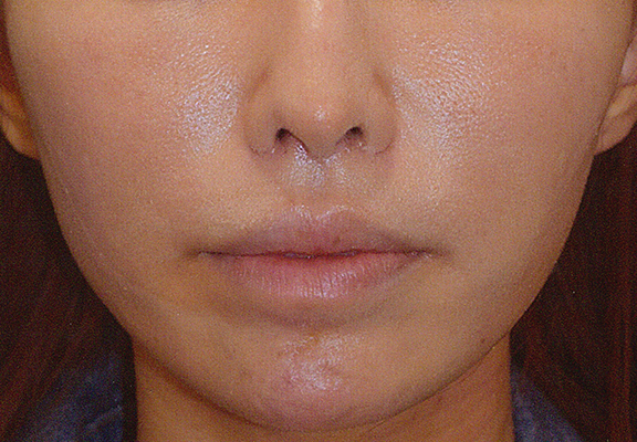 鼻の下を短く（上口唇短縮手術、上口唇リフト、リップリフト、人中短縮術）,他院で受けた手術の修正（口もと・くちびる）,人中短縮の症例写真,After（2ヶ月後）,ba_hanashita002_a01.jpg
