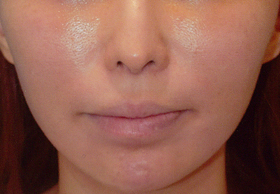 鼻の下を短く（上口唇短縮手術、上口唇リフト、リップリフト、人中短縮術）,他院で受けた手術の修正（口もと・くちびる）,人中短縮の症例写真,Before,ba_hanashita002_b01.jpg