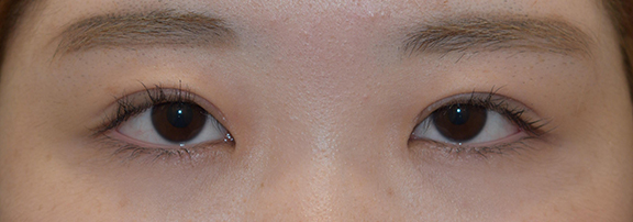 症例写真,二重まぶた・全切開法の症例 一重瞼から二重瞼になった女性,After（1ヶ月後）,ba_sekkai069_b01.jpg