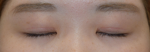 症例写真,二重まぶた・全切開法の症例 一重瞼から二重瞼になった女性,After（1ヶ月後）<br/>
（目を閉じた状態）,
