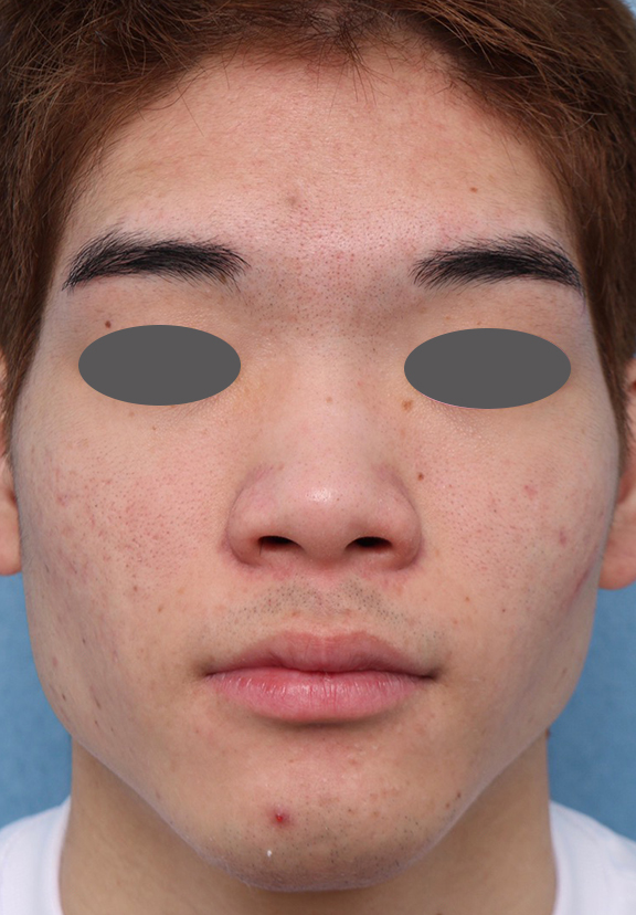 フォトフェイシャルM22,ニキビ治療の症例写真 おでこ、両頬に赤いニキビが散在している男性,After（6ヶ月後）,ba_ipl008_a01.jpg