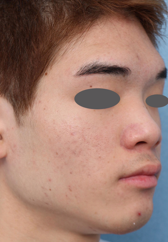 症例写真,ニキビ治療の症例写真 おでこ、両頬に赤いニキビが散在している男性,After（6ヶ月後）,ba_ipl008_b02.jpg
