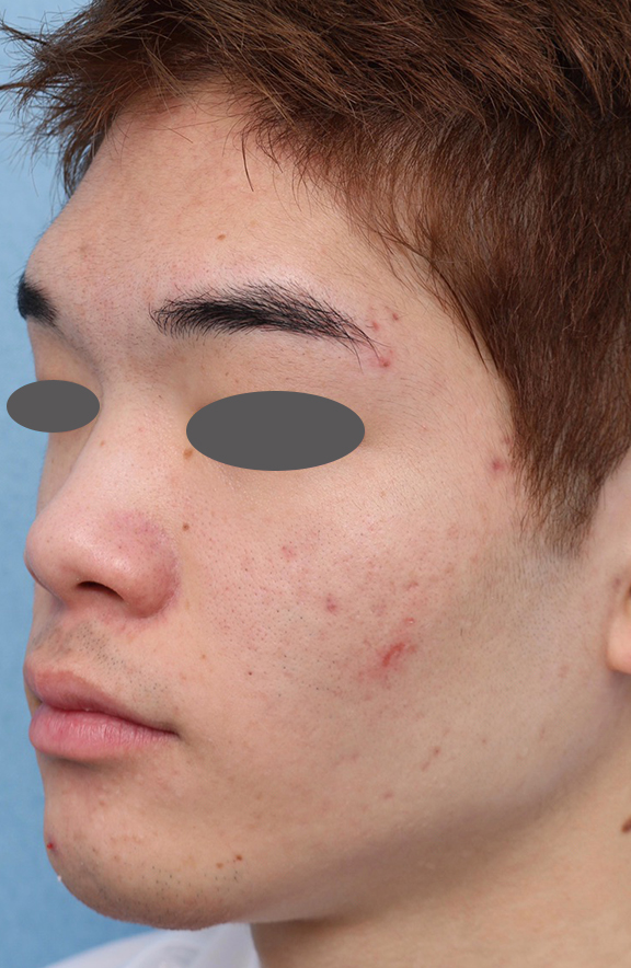 フォトフェイシャルM22,ニキビ治療の症例写真 おでこ、両頬に赤いニキビが散在している男性,After（6ヶ月後）,ba_ipl008_b03.jpg