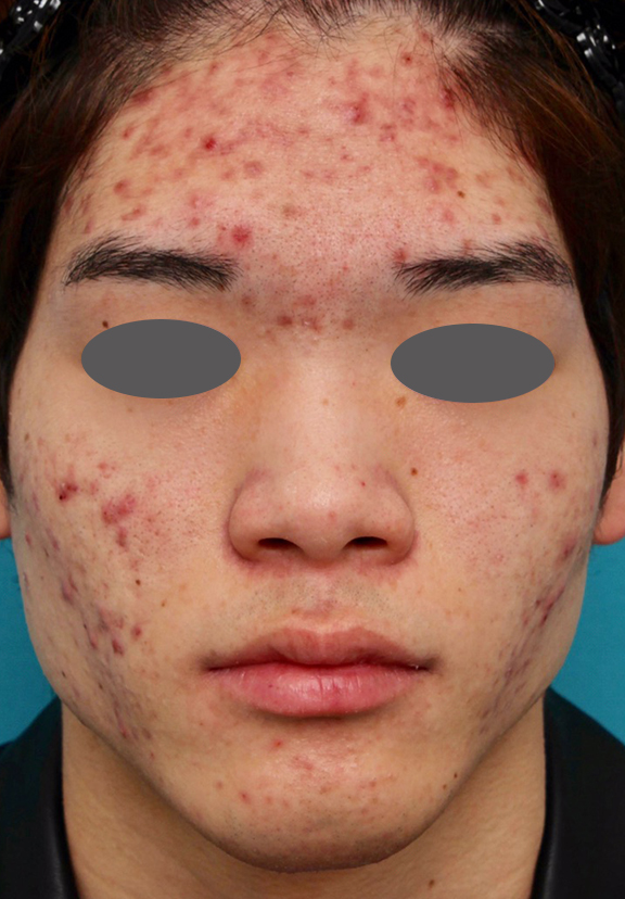 フォトフェイシャルM22,ニキビ治療の症例写真 おでこ、両頬に赤いニキビが散在している男性,Before,ba_ipl008_b01.jpg