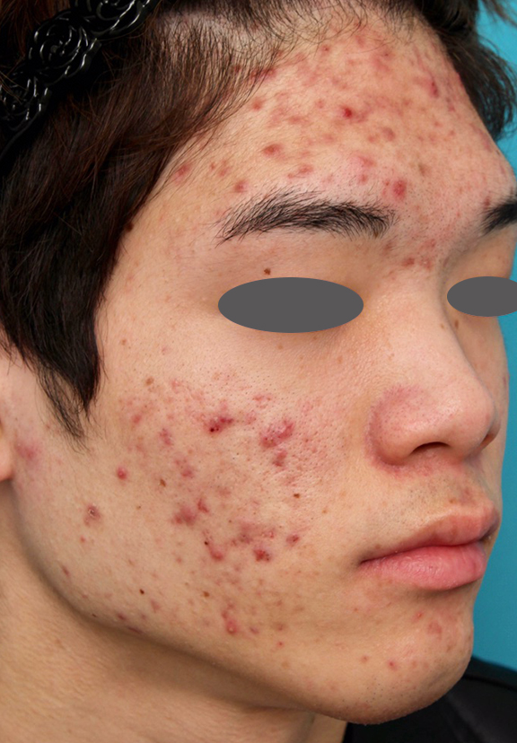 フォトフェイシャルM22,ニキビ治療の症例写真 おでこ、両頬に赤いニキビが散在している男性,Before,ba_ipl008_b02.jpg