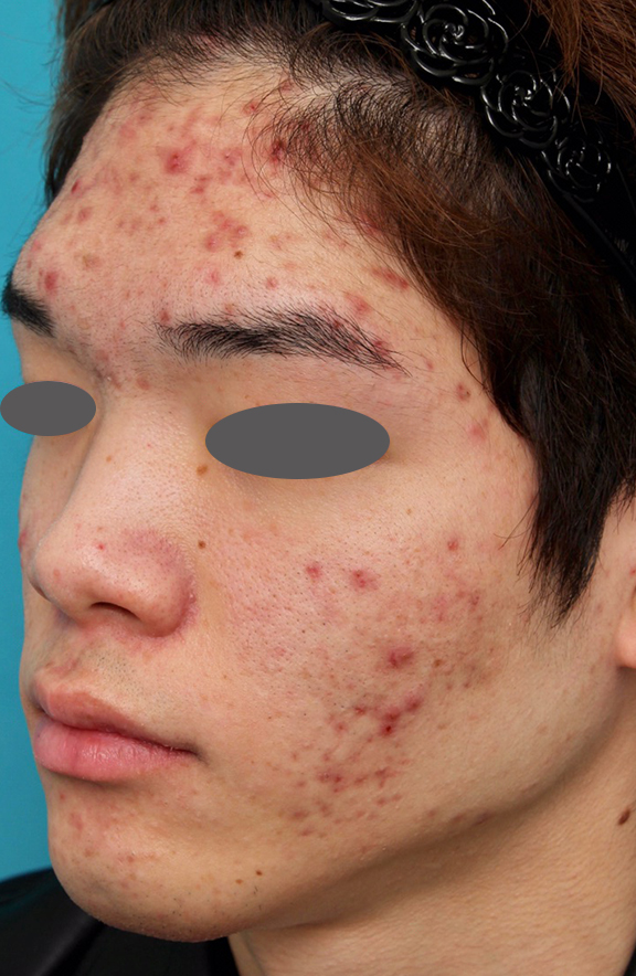 フォトフェイシャルM22,ニキビ治療の症例写真 おでこ、両頬に赤いニキビが散在している男性,Before,ba_ipl008_b03.jpg