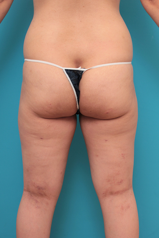 脂肪吸引,太もも、お尻から脂肪吸引し、バストに脂肪注入した30代女性の症例写真,3週間後,mainpic_inject027i.jpg