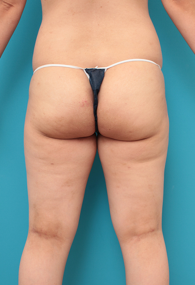 脂肪吸引,太もも、お尻から脂肪吸引し、バストに脂肪注入した30代女性の症例写真,6ヶ月後,mainpic_inject027j.jpg
