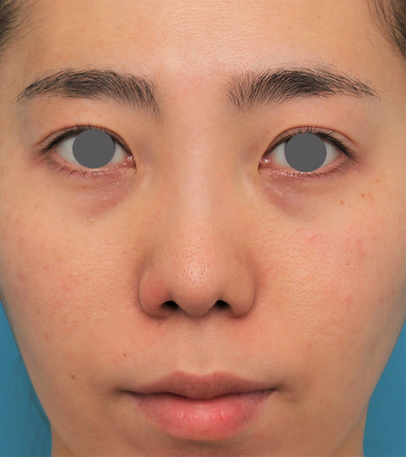 症例写真,非常に鼻の下が長い人に対して人中短縮と鼻柱への耳介軟骨移植を行った症例写真,After（6ヶ月後）,ba_hanashita003_b01.jpg