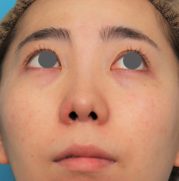 鼻の下を短く（上口唇短縮手術、上口唇リフト、リップリフト、人中短縮術）,非常に鼻の下が長い人に対して人中短縮と鼻柱への耳介軟骨移植を行った症例写真,After（6ヶ月後）,ba_hanashita003_b02.jpg