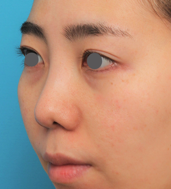 鼻の下を短く（上口唇短縮手術、上口唇リフト、リップリフト、人中短縮術）,非常に鼻の下が長い人に対して人中短縮と鼻柱への耳介軟骨移植を行った症例写真,After（6ヶ月後）,ba_hanashita003_b03.jpg