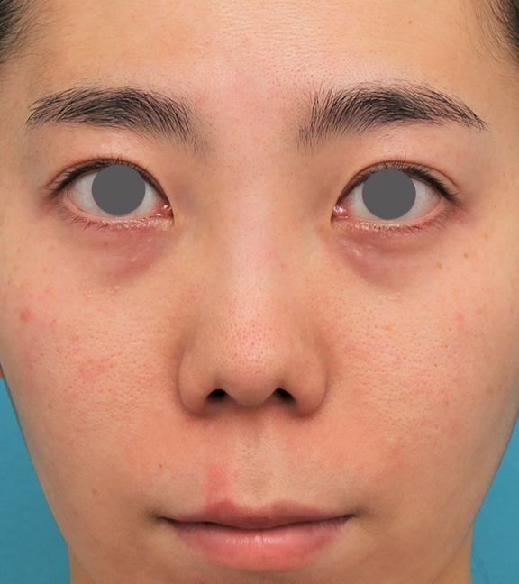 鼻の下を短く（上口唇短縮手術、上口唇リフト、リップリフト、人中短縮術）,非常に鼻の下が長い人に対して人中短縮と鼻柱への耳介軟骨移植を行った症例写真,Before,ba_hanashita003_b01.jpg