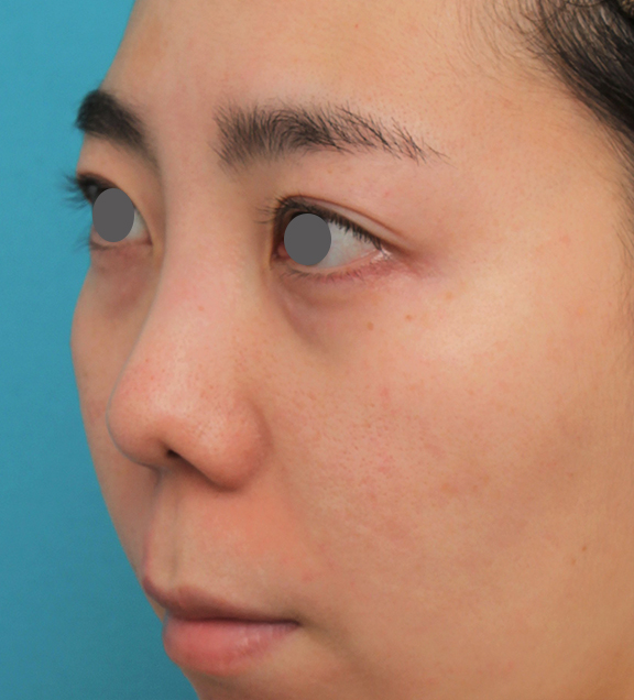 鼻の下を短く（上口唇短縮手術、上口唇リフト、リップリフト、人中短縮術）,非常に鼻の下が長い人に対して人中短縮と鼻柱への耳介軟骨移植を行った症例写真,Before,ba_hanashita003_b03.jpg