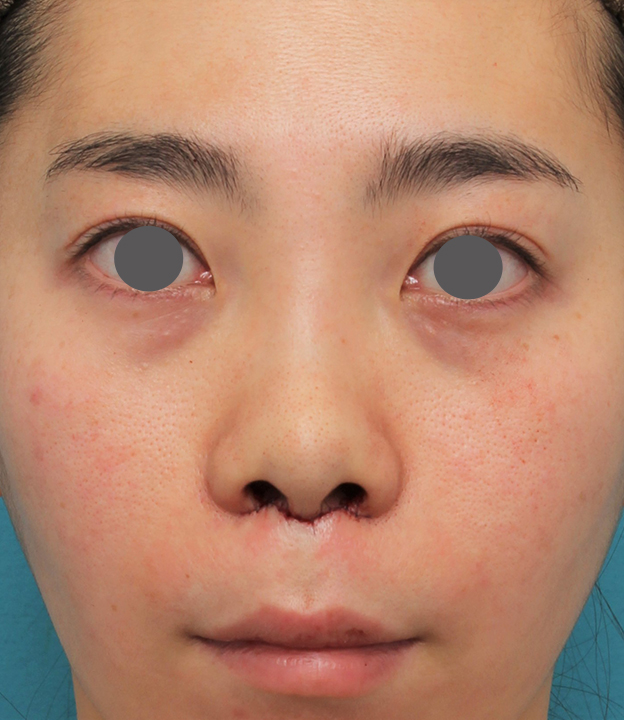 症例写真,非常に鼻の下が長い人に対して人中短縮と鼻柱への耳介軟骨移植を行った症例写真,手術直後,mainpic_hanashita003b.jpg