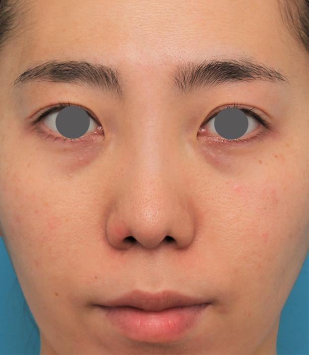 症例写真,非常に鼻の下が長い人に対して人中短縮と鼻柱への耳介軟骨移植を行った症例写真,6ヶ月後,mainpic_hanashita003e.jpg