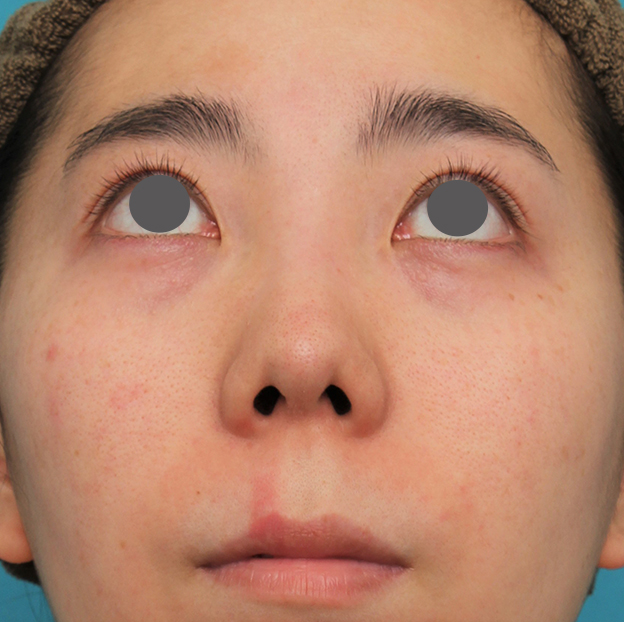 症例写真,非常に鼻の下が長い人に対して人中短縮と鼻柱への耳介軟骨移植を行った症例写真,手術前,mainpic_hanashita003f.jpg