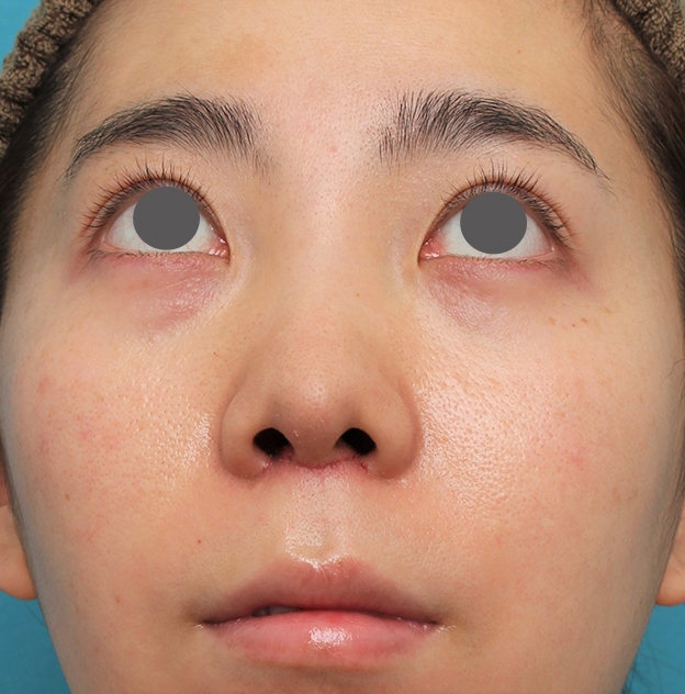 耳介軟骨移植（鼻先を出す）,非常に鼻の下が長い人に対して人中短縮と鼻柱への耳介軟骨移植を行った症例写真,6日後,mainpic_hanashita003h.jpg