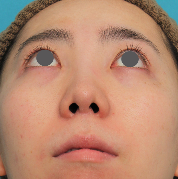 症例写真,非常に鼻の下が長い人に対して人中短縮と鼻柱への耳介軟骨移植を行った症例写真,3週間後,mainpic_hanashita003i.jpg
