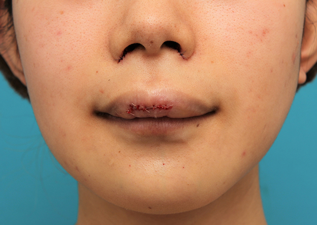 唇を薄く（口唇縮小術）,上唇の真ん中の出っ張り（上唇結節）を手術で切除して目立たなくした症例写真,手術直後,mainpic_usuku014c.jpg