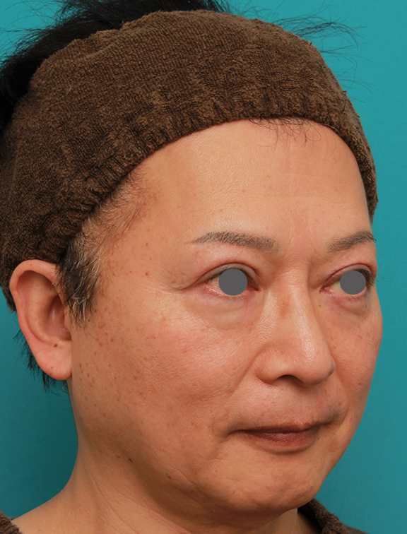 隆鼻術（シリコンプロテーゼ）,50代の男性の鼻にシリコンプロテーゼを入れて鼻筋を通した症例写真,After（2ヶ月後）,ba_ryubi1056_b02.jpg