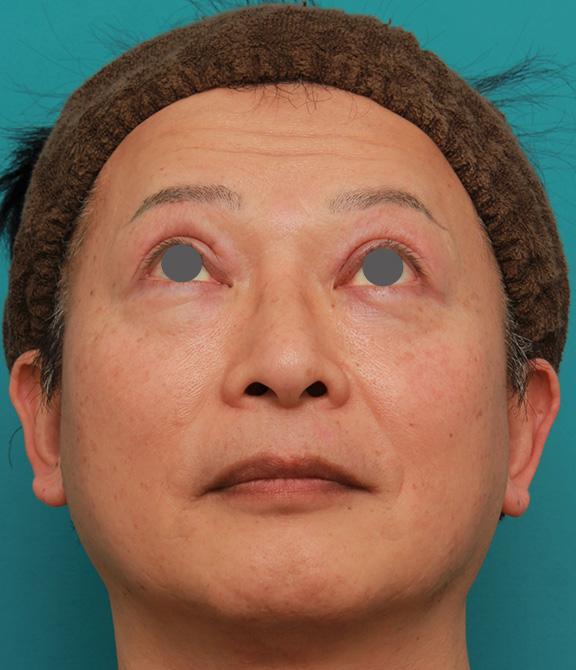 隆鼻術（シリコンプロテーゼ）,50代の男性の鼻にシリコンプロテーゼを入れて鼻筋を通した症例写真,After（2ヶ月後）,ba_ryubi1056_b03.jpg