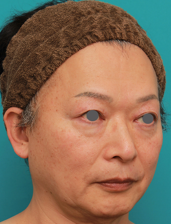 隆鼻術（シリコンプロテーゼ）,50代の男性の鼻にシリコンプロテーゼを入れて鼻筋を通した症例写真,Before,ba_ryubi1056_b02.jpg