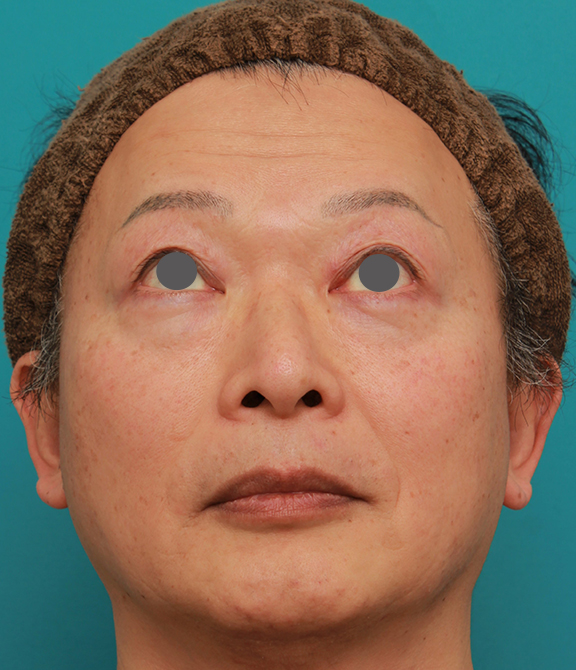 隆鼻術（シリコンプロテーゼ）,50代の男性の鼻にシリコンプロテーゼを入れて鼻筋を通した症例写真,Before,ba_ryubi1056_b03.jpg