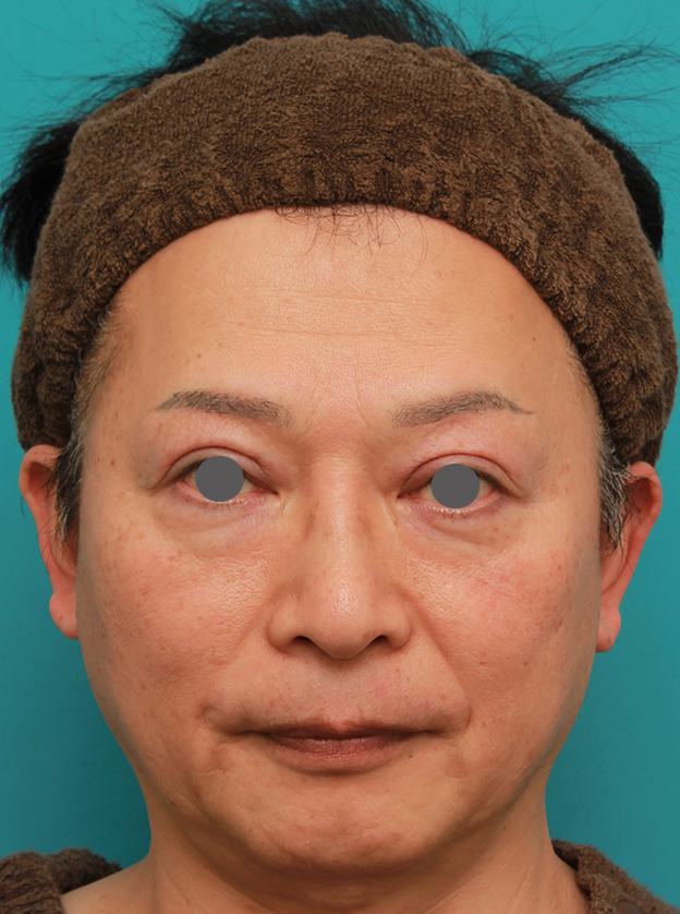 隆鼻術（シリコンプロテーゼ）,50代の男性の鼻にシリコンプロテーゼを入れて鼻筋を通した症例写真,2ヶ月後,mainpic_ryubi1056d.jpg