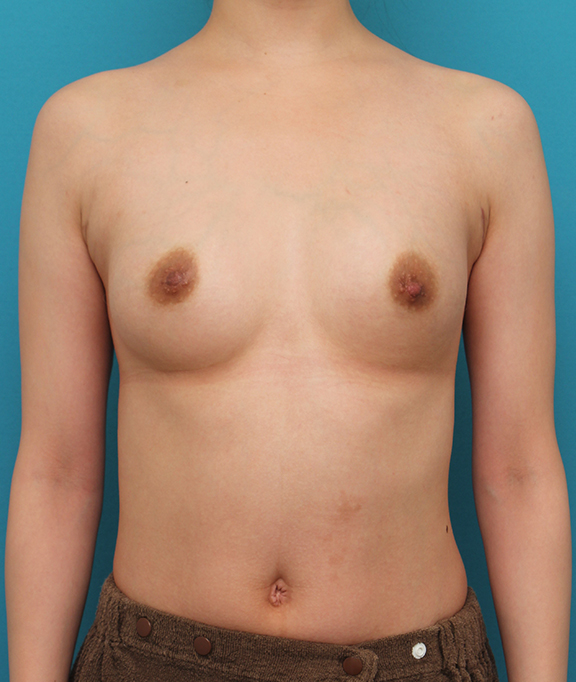 豊胸手術（シリコンプロテーゼ）,出産、授乳後の萎んだバストに豊胸手術を行った症例写真,After（6ヶ月後）,ba_hokyo034_a01.jpg