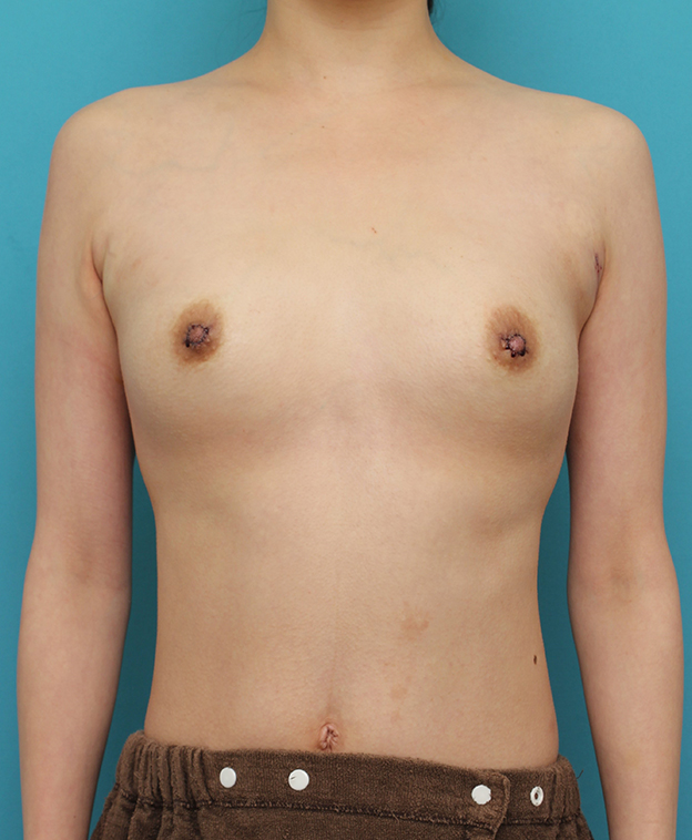 豊胸手術（シリコンプロテーゼ）,出産、授乳後の萎んだバストに豊胸手術を行った症例写真,手術直後,mainpic_hokyo034b.jpg