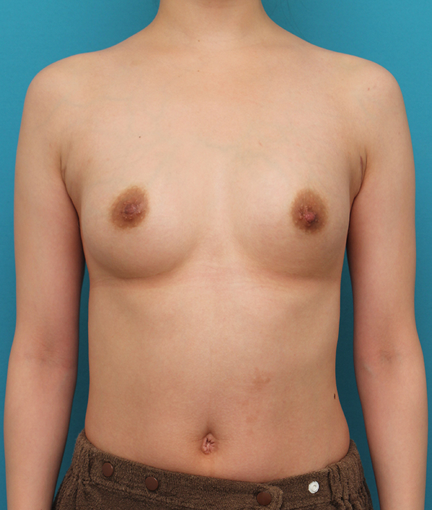 豊胸手術（シリコンプロテーゼ）,出産、授乳後の萎んだバストに豊胸手術を行った症例写真,6ヶ月後,mainpic_hokyo034e.jpg