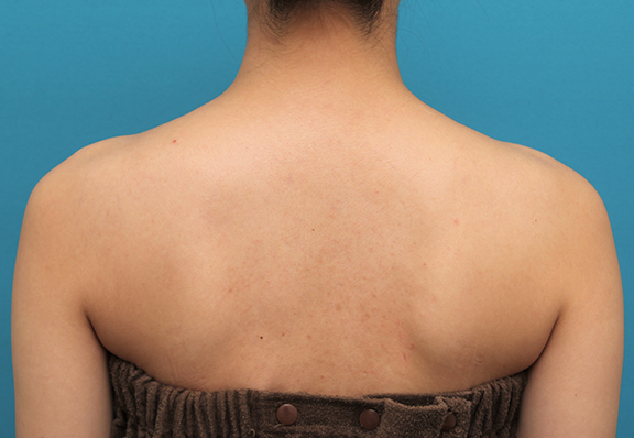 ボツリヌストキシン注射（美人肩）,発達した肩の筋肉にボツリヌストキシン注射をし、綺麗なシルエットにした20代女性の症例写真,After（1ヶ月半後）,ba_beautiful_shoulder_botox006_b02.jpg