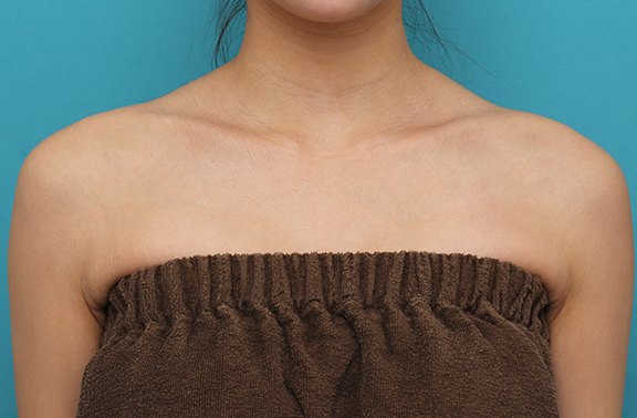 ボツリヌストキシン注射（美人肩）,発達した肩の筋肉にボツリヌストキシン注射をし、綺麗なシルエットにした20代女性の症例写真,Before,ba_beautiful_shoulder_botox006_b01.jpg