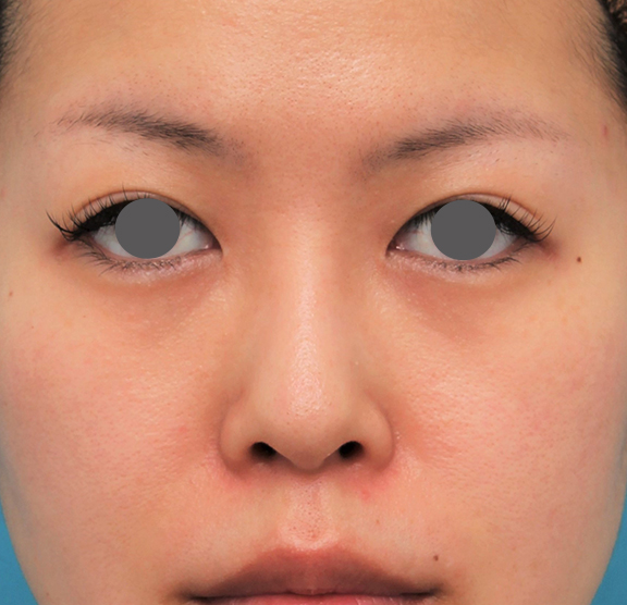 隆鼻術（シリコンプロテーゼ）,鼻にシリコンプロテーゼを入れ、自然な範囲内で鼻筋を通した症例写真,After（6ヶ月後）,ba_ryubi1057_b01.jpg