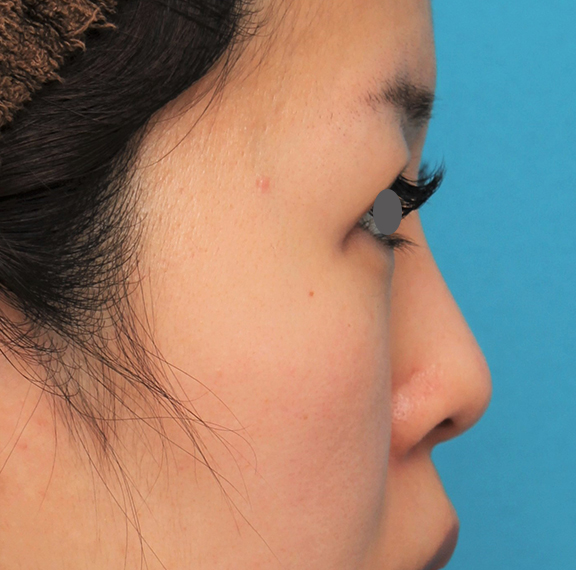 隆鼻術（シリコンプロテーゼ）,鼻にシリコンプロテーゼを入れ、自然な範囲内で鼻筋を通した症例写真,After（6ヶ月後）,ba_ryubi1057_b03.jpg